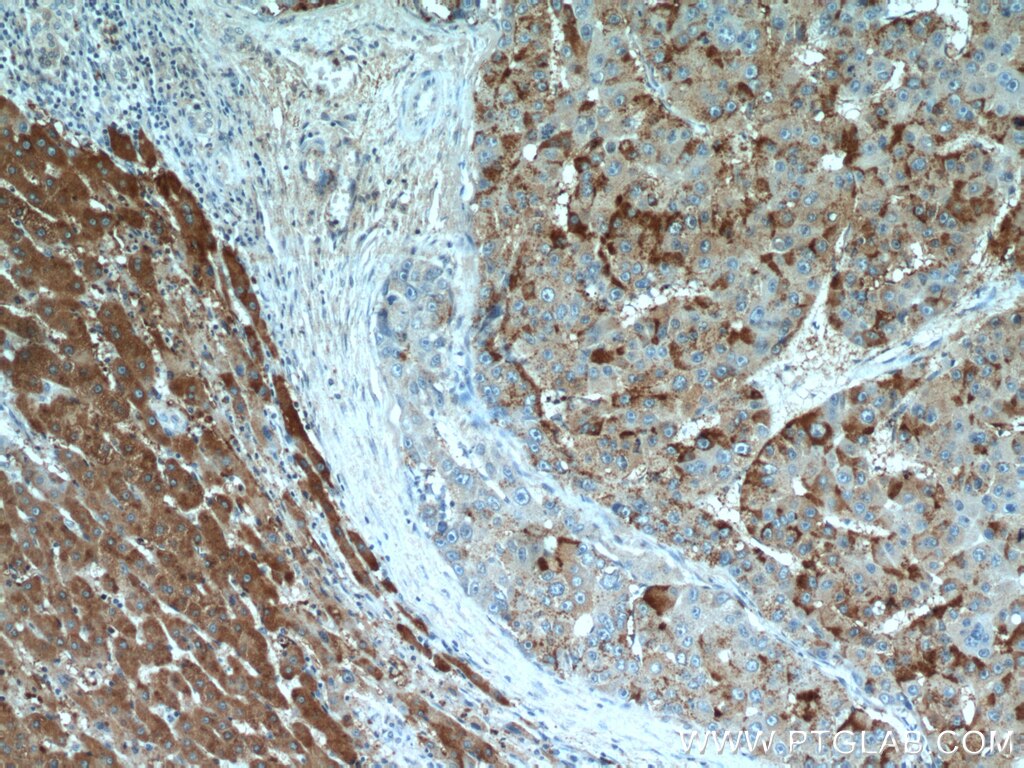 Immunohistochemistry (IHC) staining of human liver cancer tissue using TRMT2B Polyclonal antibody (20767-1-AP)