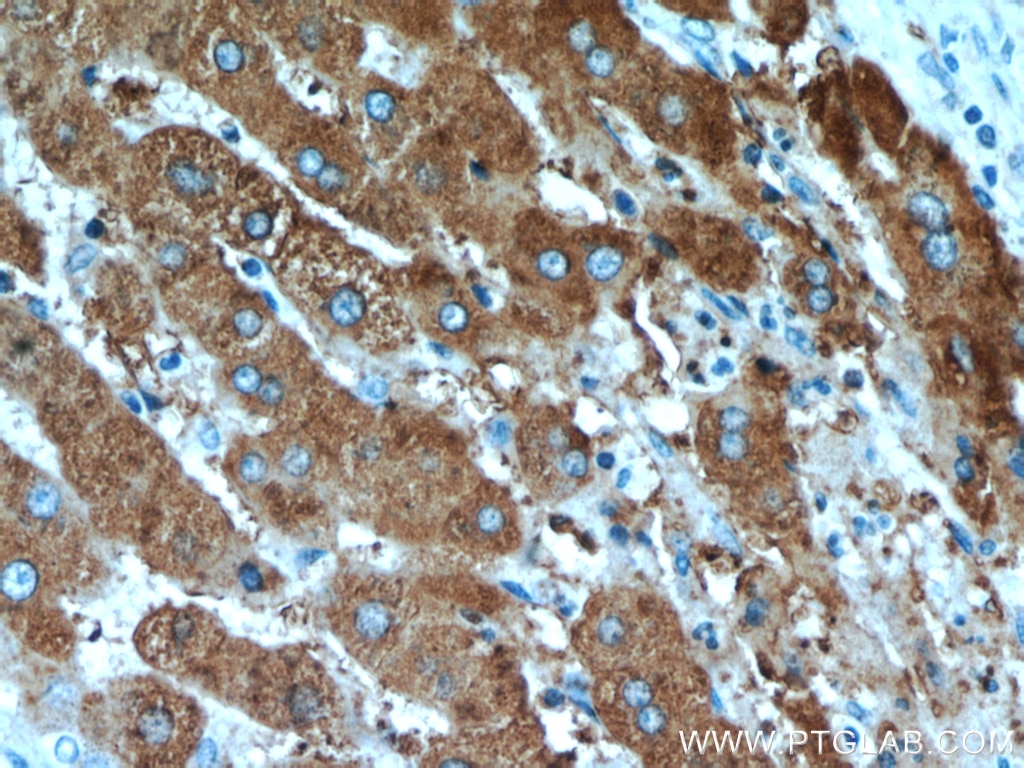 Immunohistochemistry (IHC) staining of human liver cancer tissue using TRMT2B Polyclonal antibody (20767-1-AP)