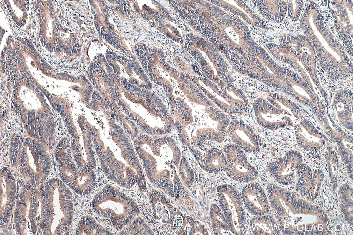 Immunohistochemistry (IHC) staining of human colon cancer tissue using TRMT61B Polyclonal antibody (26009-1-AP)