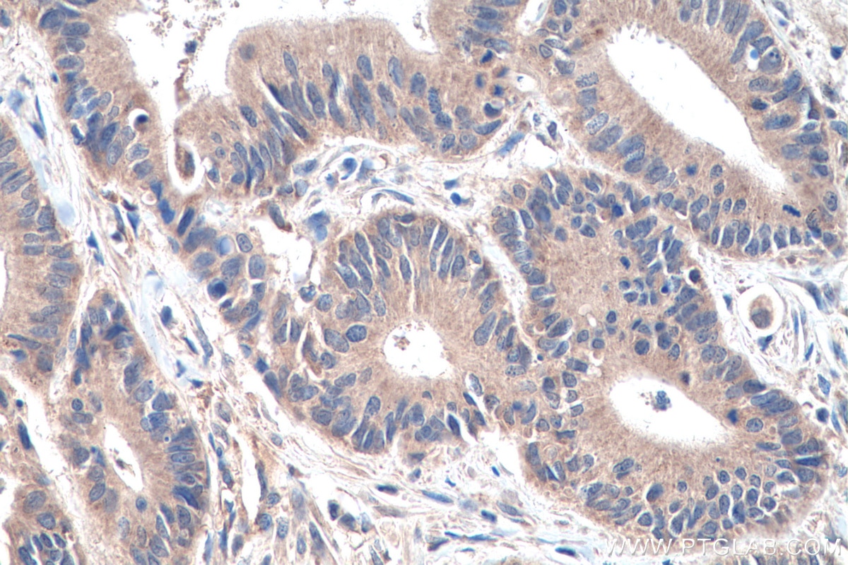 Immunohistochemistry (IHC) staining of human colon cancer tissue using TRMT61B Polyclonal antibody (26009-1-AP)