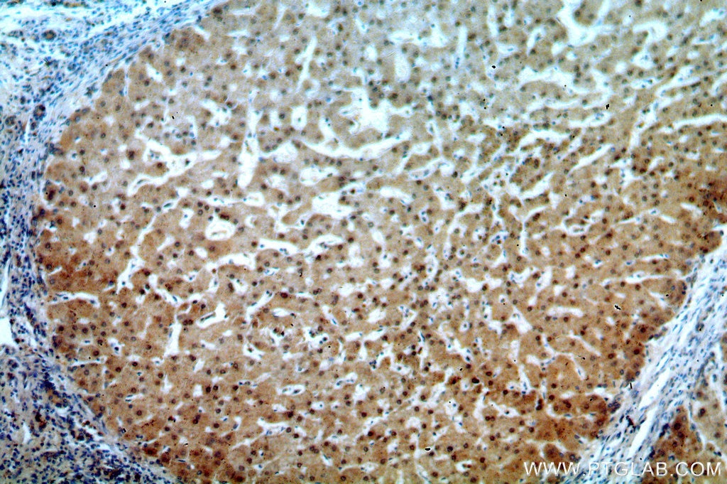 Immunohistochemistry (IHC) staining of human hepatocirrhosis tissue using TRNAU1AP,SECP43 Polyclonal antibody (15053-1-AP)
