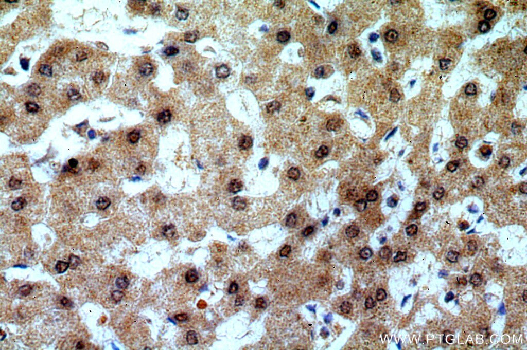 Immunohistochemistry (IHC) staining of human hepatocirrhosis tissue using TRNAU1AP,SECP43 Polyclonal antibody (15053-1-AP)