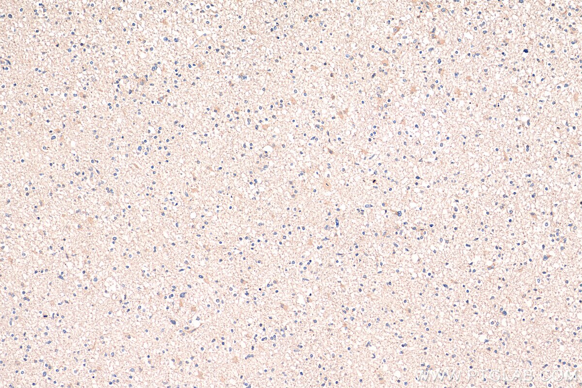 Immunohistochemistry (IHC) staining of human gliomas tissue using TROAP Polyclonal antibody (13634-1-AP)