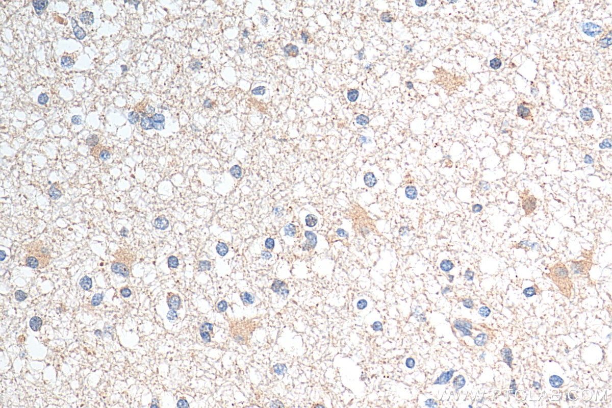 Immunohistochemistry (IHC) staining of human gliomas tissue using TROAP Polyclonal antibody (13634-1-AP)