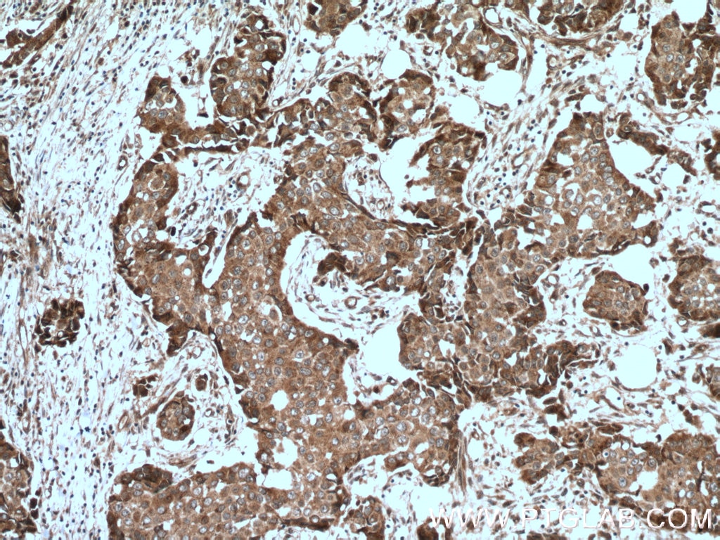 Immunohistochemistry (IHC) staining of human breast cancer tissue using TRPC4AP Polyclonal antibody (12606-1-AP)