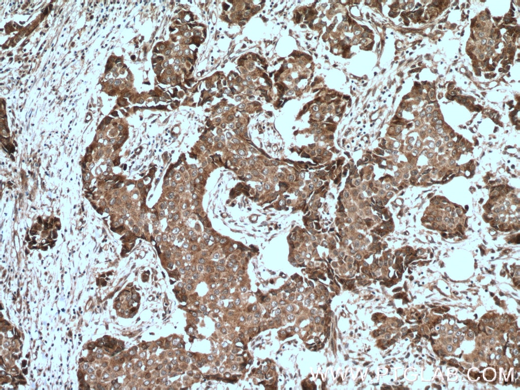 IHC staining of human breast cancer using 12606-1-AP