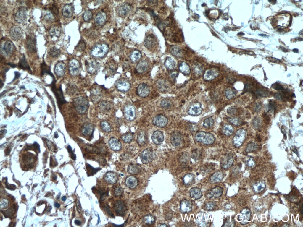 Immunohistochemistry (IHC) staining of human breast cancer tissue using TRPC4AP Polyclonal antibody (12606-1-AP)