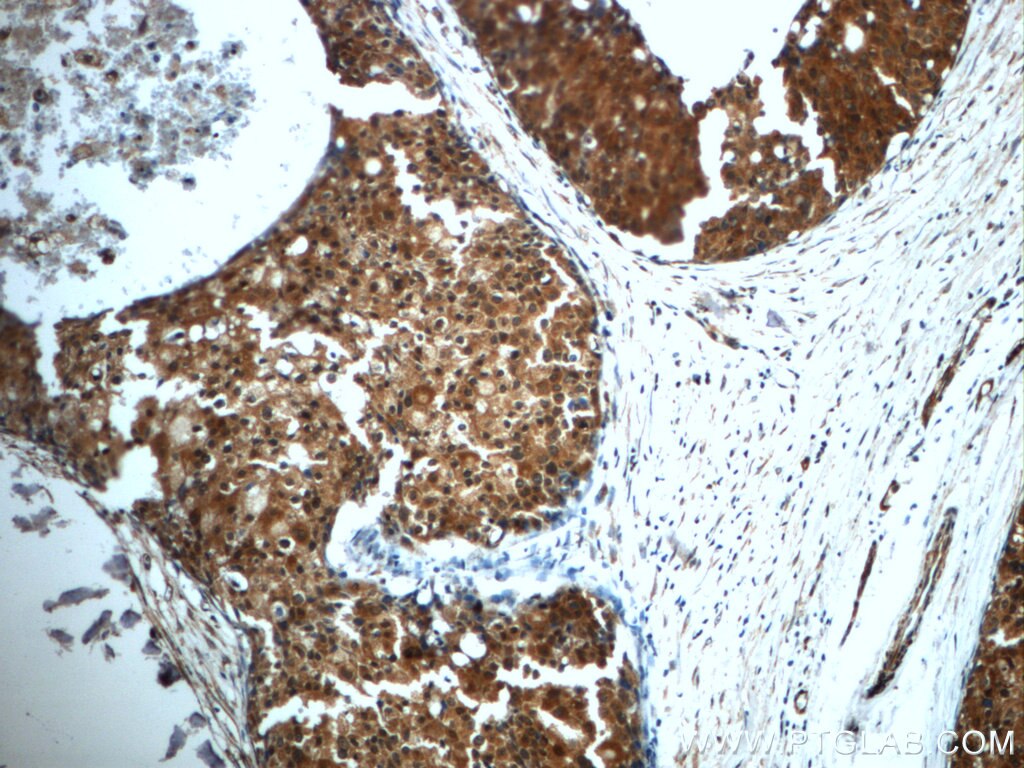 IHC staining of human breast cancer using 12606-1-AP