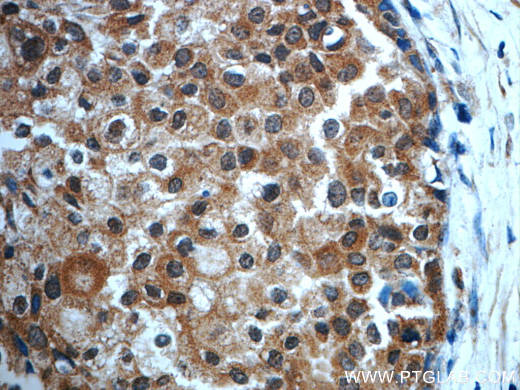 Immunohistochemistry (IHC) staining of human breast cancer tissue using TRPC4AP Polyclonal antibody (12606-1-AP)