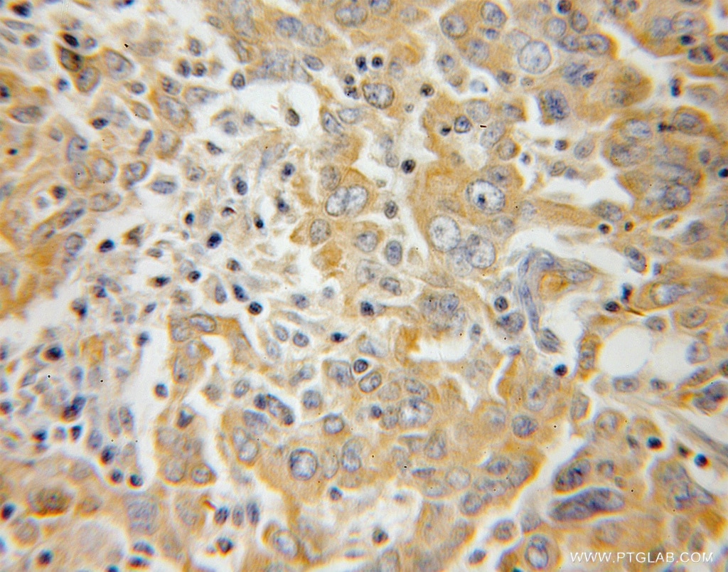 Immunohistochemistry (IHC) staining of human breast cancer tissue using TRPC4AP Polyclonal antibody (12606-1-AP)