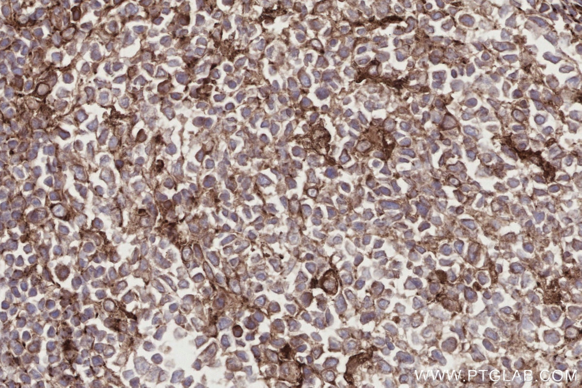 Immunohistochemistry (IHC) staining of human appendicitis tissue using TRPC4AP Polyclonal antibody (29310-1-AP)