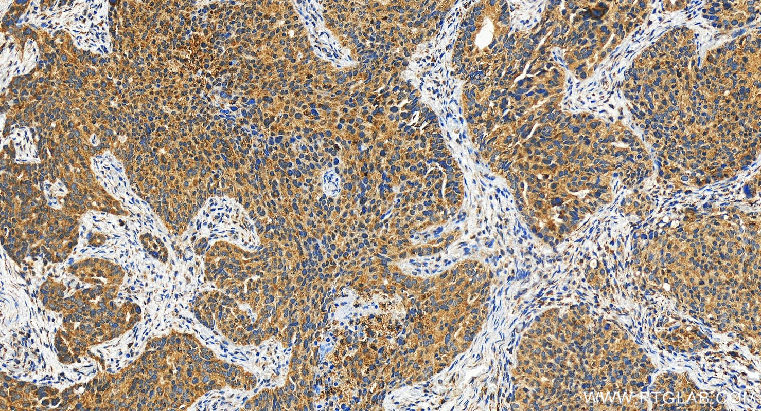 Immunohistochemistry (IHC) staining of human ovary cancer tissue using TRPC4AP Polyclonal antibody (29310-1-AP)