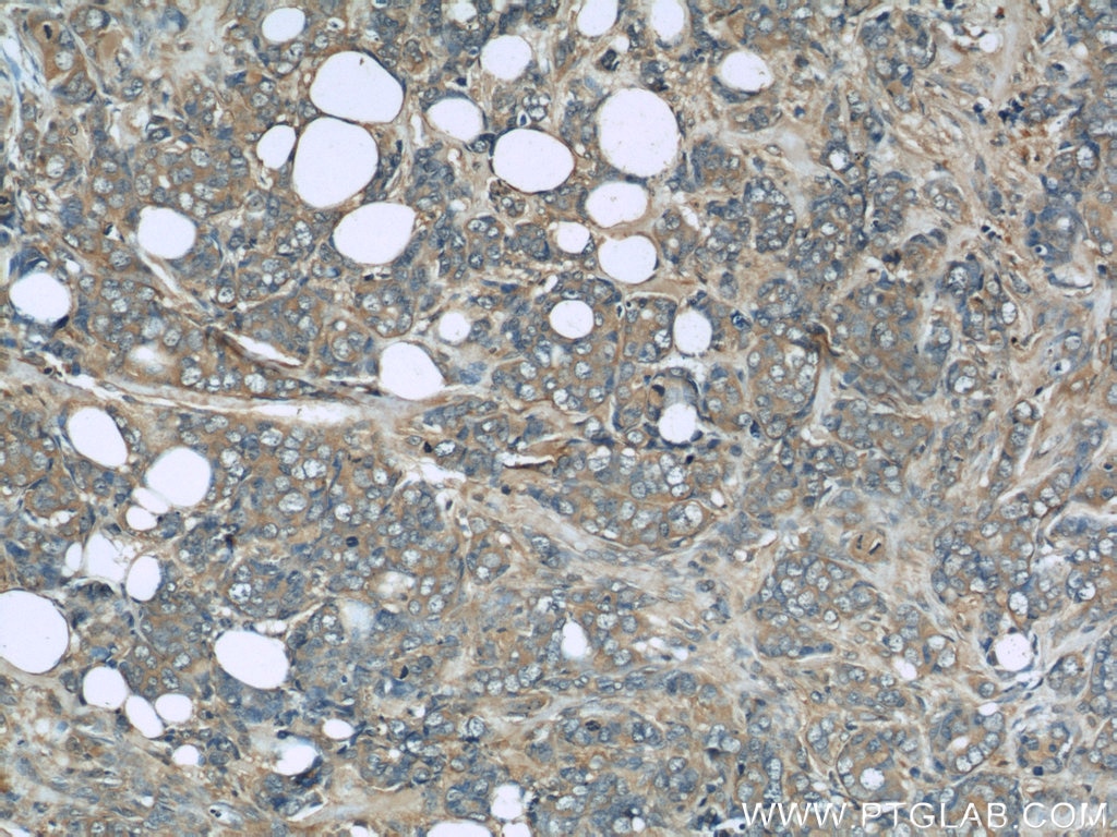 Immunohistochemistry (IHC) staining of human breast cancer tissue using TRPC4AP Monoclonal antibody (66138-1-Ig)