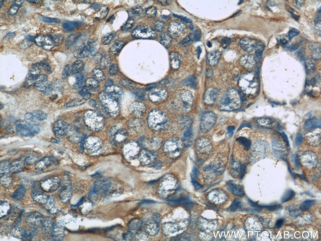 Immunohistochemistry (IHC) staining of human breast cancer tissue using TRPC4AP Monoclonal antibody (66138-1-Ig)