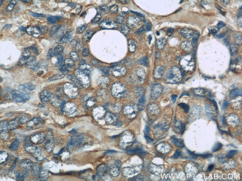 IHC staining of human breast cancer using 66138-1-Ig