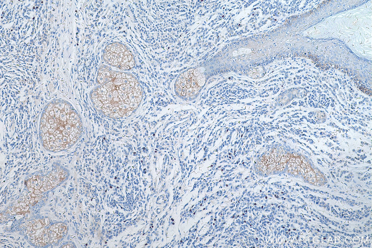 Immunohistochemistry (IHC) staining of human malignant melanoma tissue using TRPM1 Polyclonal antibody (55111-1-AP)