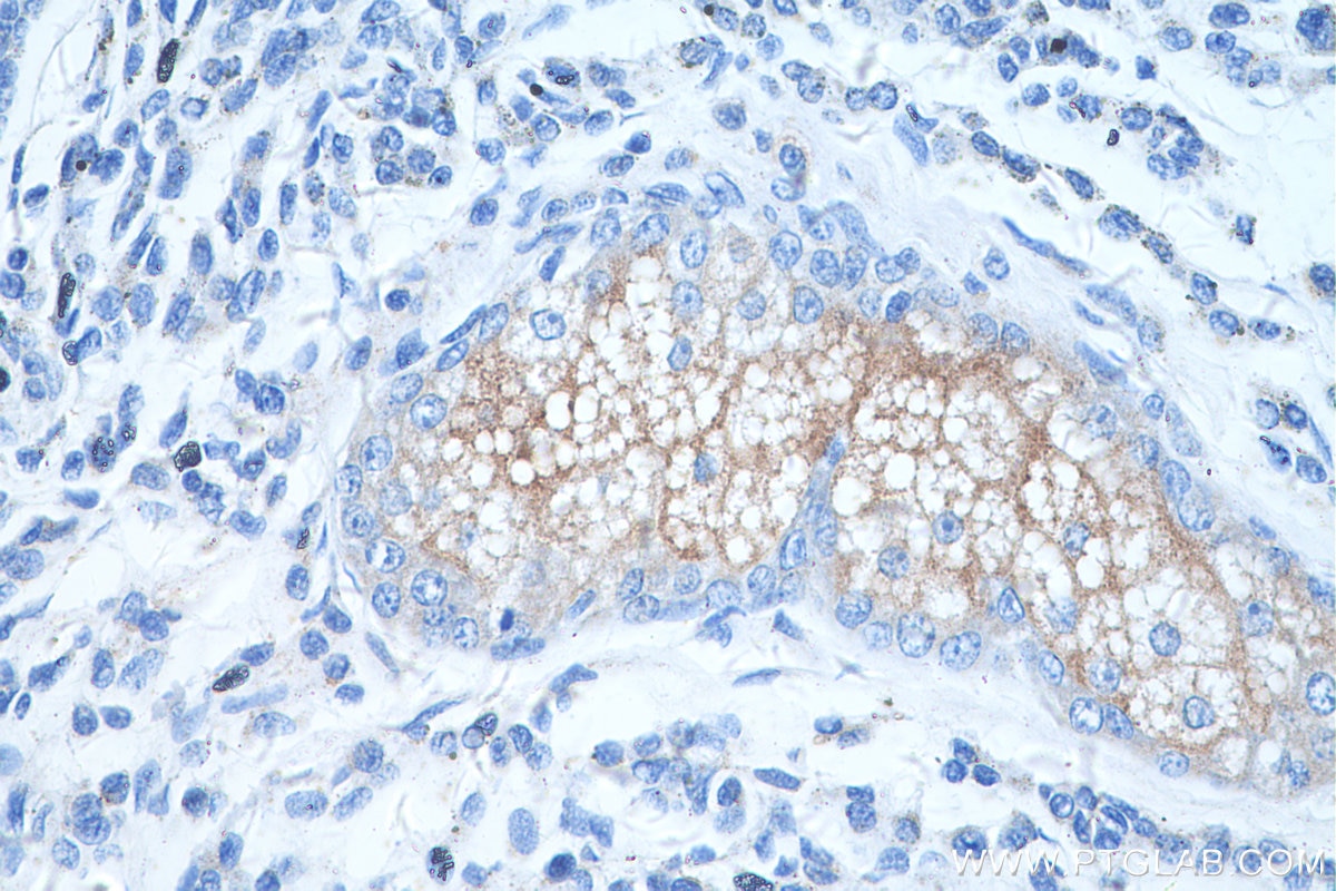 Immunohistochemistry (IHC) staining of human malignant melanoma tissue using TRPM1 Polyclonal antibody (55111-1-AP)