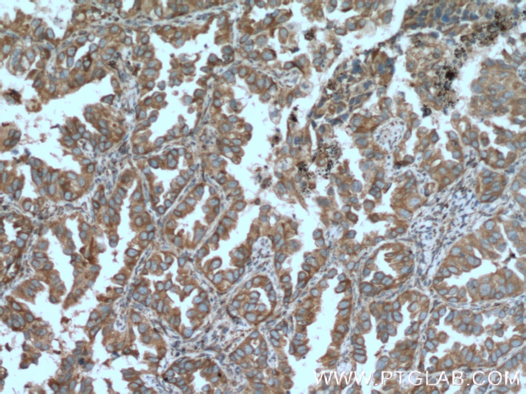 Immunohistochemistry (IHC) staining of human lung cancer tissue using TRPM1 Polyclonal antibody (55111-1-AP)