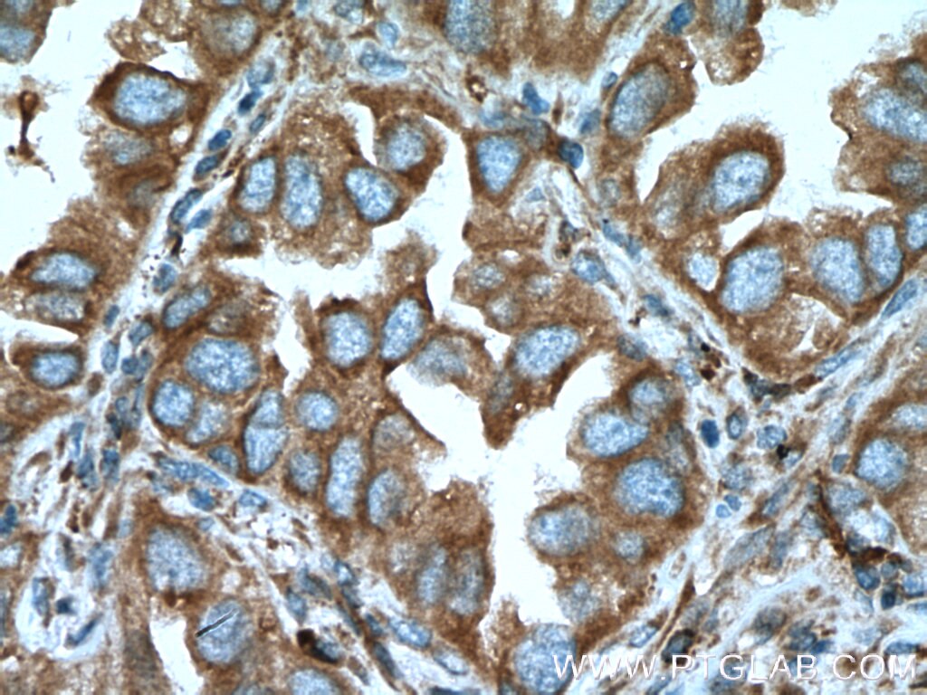 Immunohistochemistry (IHC) staining of human lung cancer tissue using TRPM1 Polyclonal antibody (55111-1-AP)