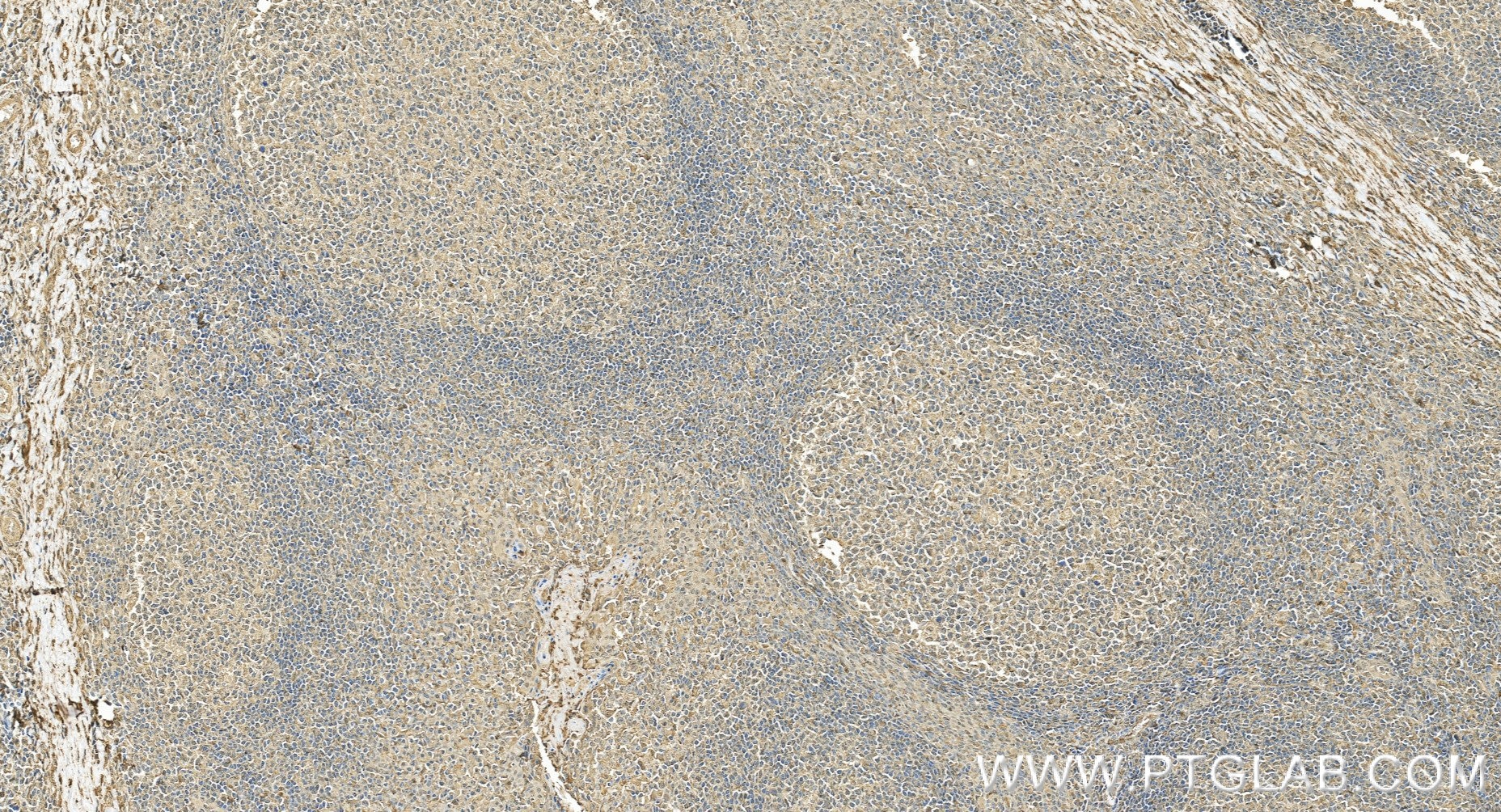 Immunohistochemistry (IHC) staining of human tonsillitis tissue using Anti-Human TRPM7 Rabbit Recombinant Antibody (98602-3-RR)