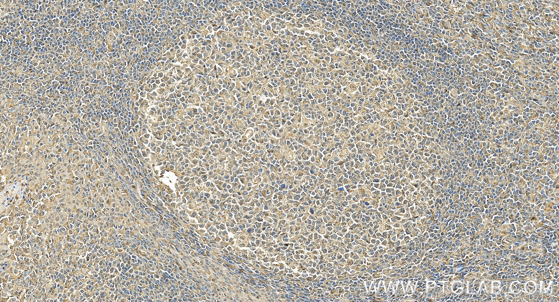 Immunohistochemistry (IHC) staining of human tonsillitis tissue using Anti-Human TRPM7 Rabbit Recombinant Antibody (98602-3-RR)