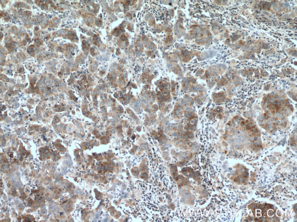 Immunohistochemistry (IHC) staining of human prostate cancer tissue using TRPM8 Polyclonal antibody (12813-1-AP)