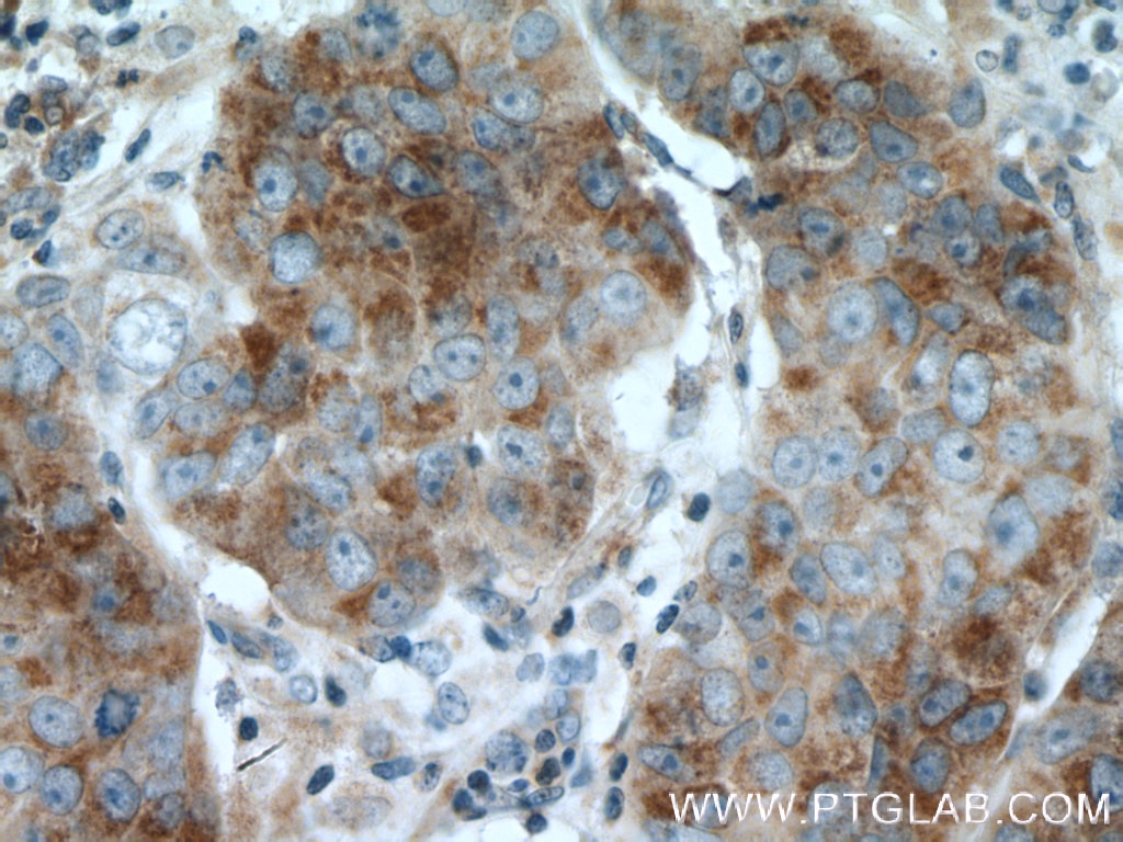 Immunohistochemistry (IHC) staining of human prostate cancer tissue using TRPM8 Polyclonal antibody (12813-1-AP)