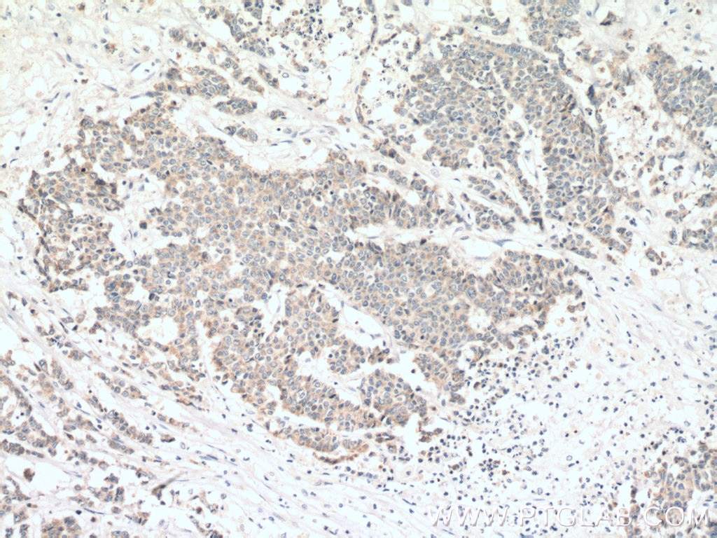 IHC staining of human colon cancer using 12813-1-AP