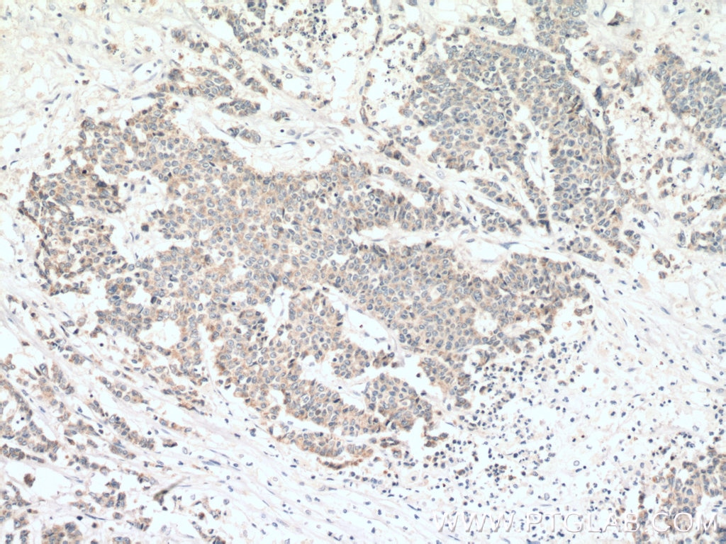 Immunohistochemistry (IHC) staining of human colon cancer tissue using TRPM8 Polyclonal antibody (12813-1-AP)