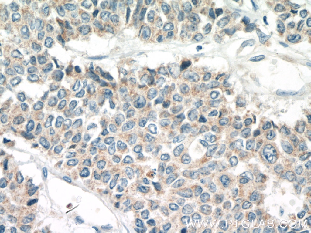 Immunohistochemistry (IHC) staining of human colon cancer tissue using TRPM8 Polyclonal antibody (12813-1-AP)
