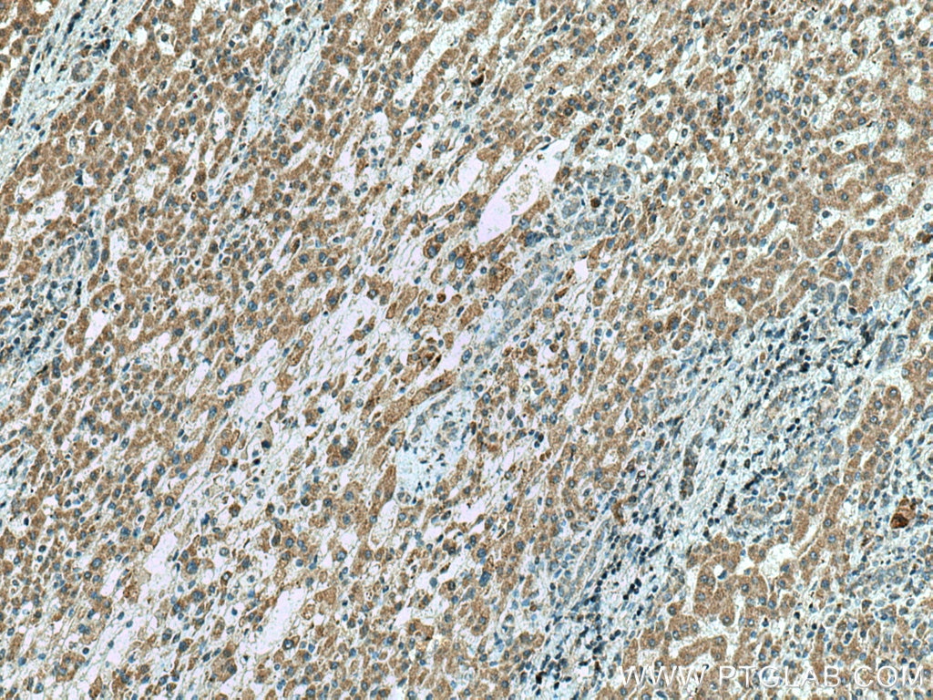 Immunohistochemistry (IHC) staining of human liver cancer tissue using TRPM8 Polyclonal antibody (12813-1-AP)
