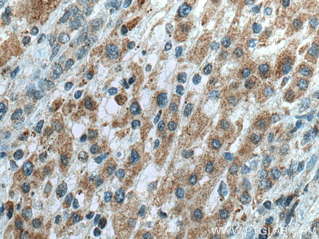 Immunohistochemistry (IHC) staining of human liver cancer tissue using TRPM8 Polyclonal antibody (12813-1-AP)