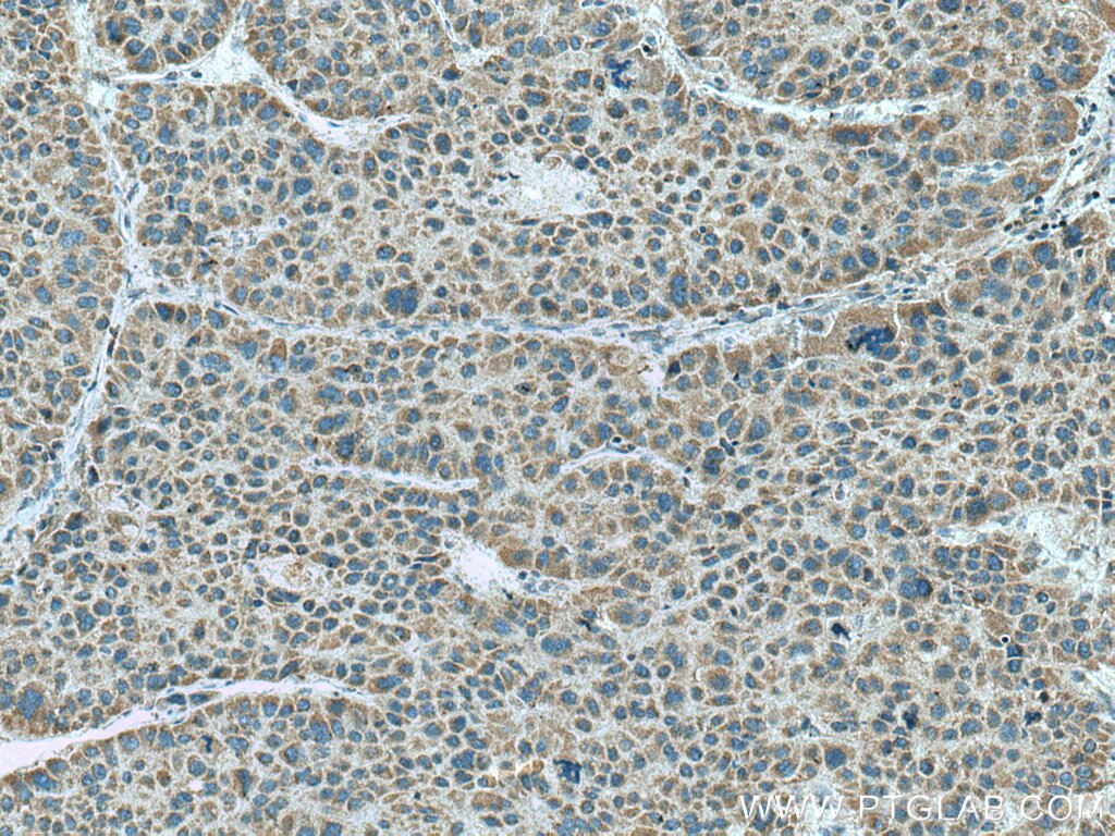 Immunohistochemistry (IHC) staining of human liver cancer tissue using TRPM8 Polyclonal antibody (12813-1-AP)