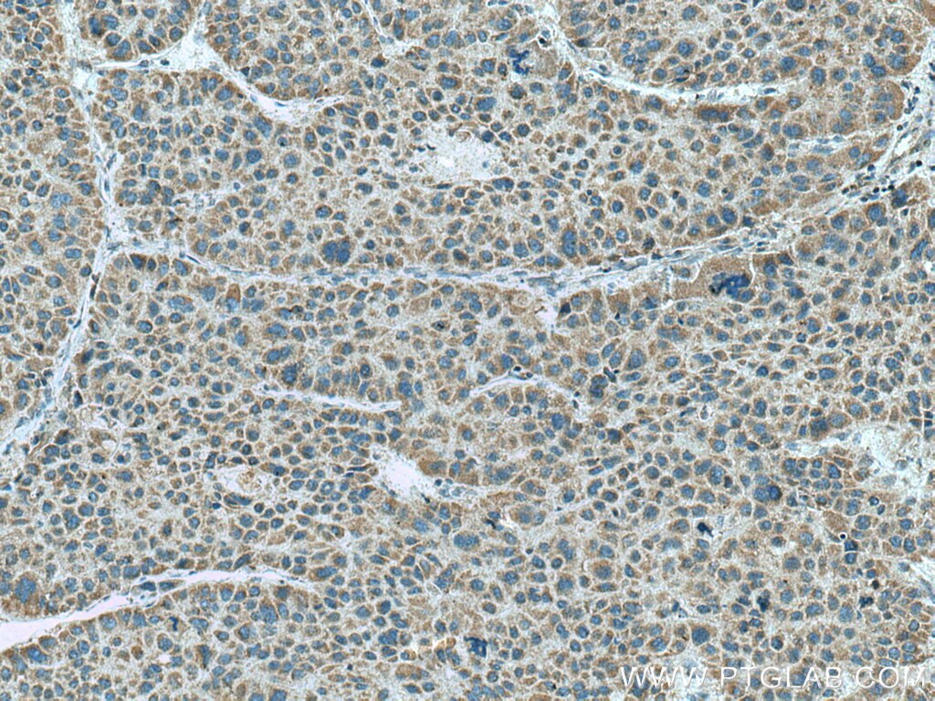 Immunohistochemistry (IHC) staining of human liver cancer tissue using TRPM8 Polyclonal antibody (12813-1-AP)