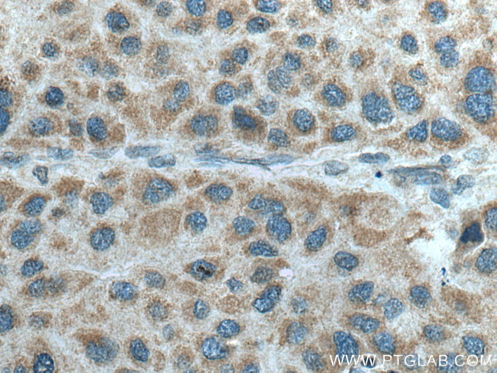 Immunohistochemistry (IHC) staining of human liver cancer tissue using TRPM8 Polyclonal antibody (12813-1-AP)