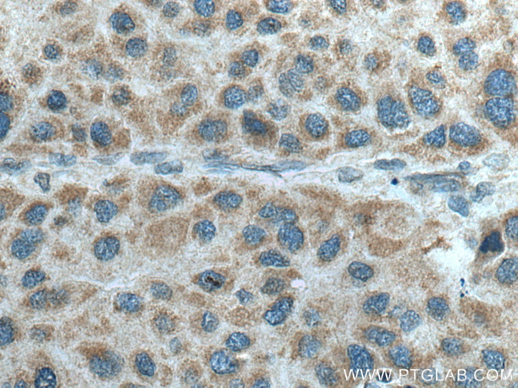 IHC staining of human liver cancer using 12813-1-AP