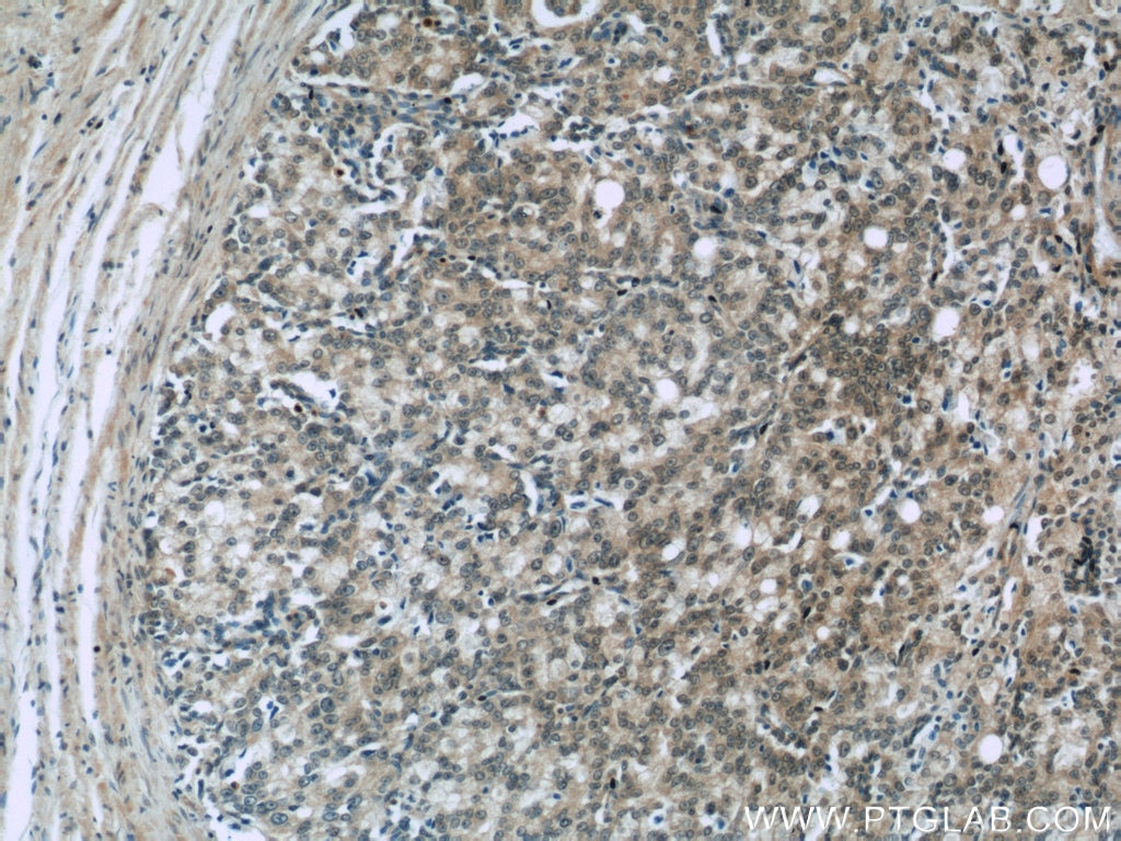 Immunohistochemistry (IHC) staining of human prostate cancer tissue using TRPS1 Polyclonal antibody (20003-1-AP)