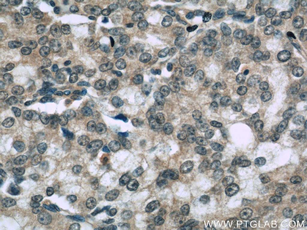 Immunohistochemistry (IHC) staining of human prostate cancer tissue using TRPS1 Polyclonal antibody (20003-1-AP)