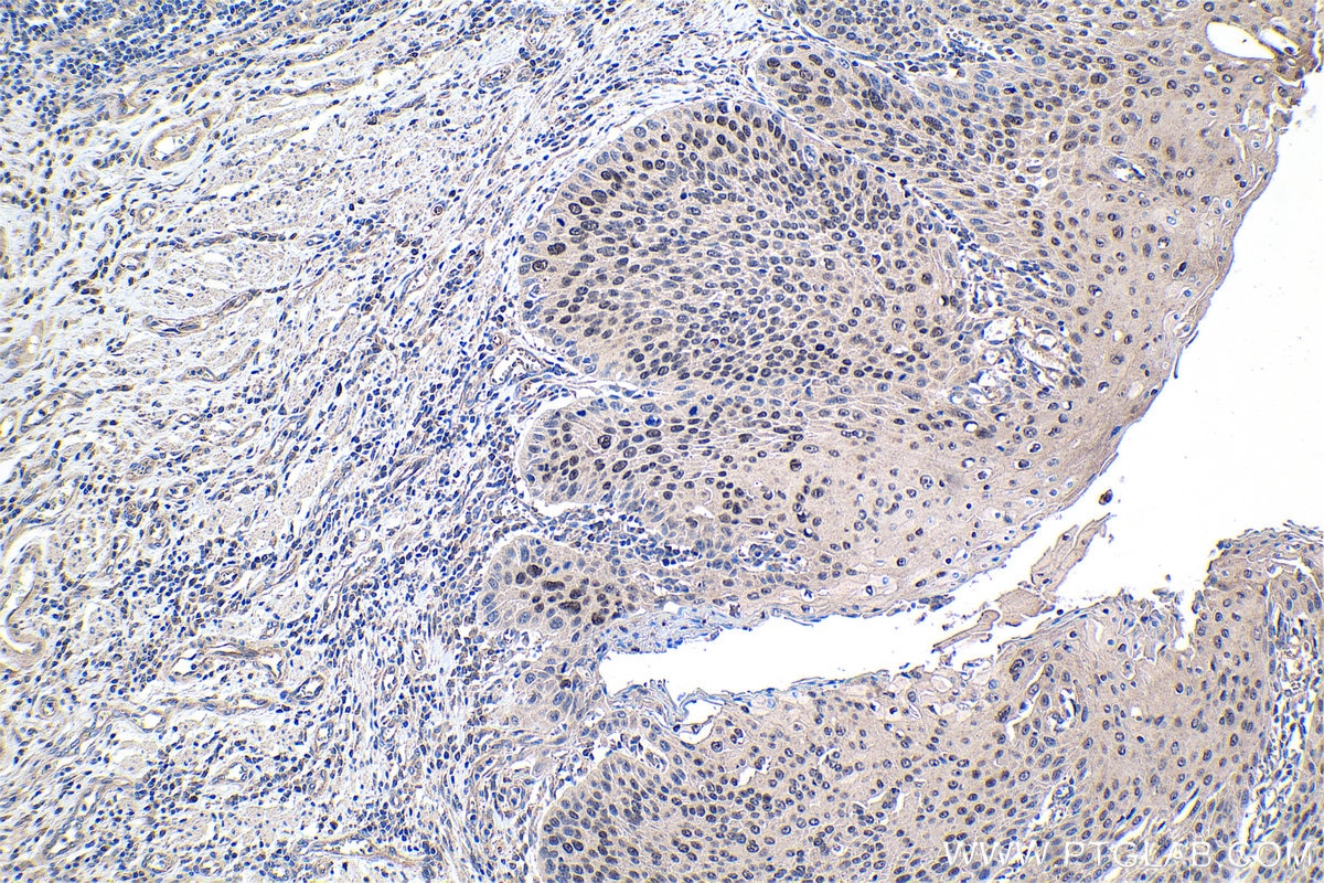 Immunohistochemistry (IHC) staining of human oesophagus cancer tissue using TRPS1 Polyclonal antibody (21938-1-AP)