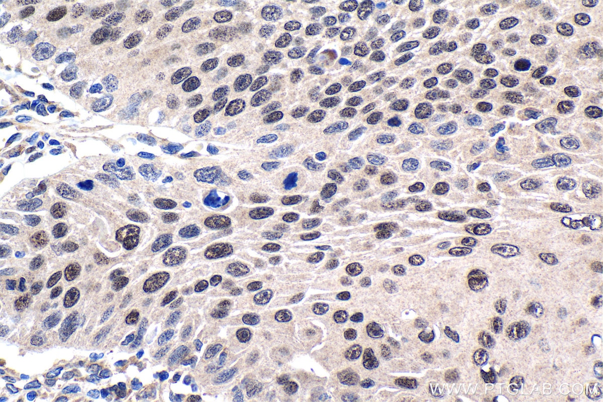Immunohistochemistry (IHC) staining of human oesophagus cancer tissue using TRPS1 Polyclonal antibody (21938-1-AP)