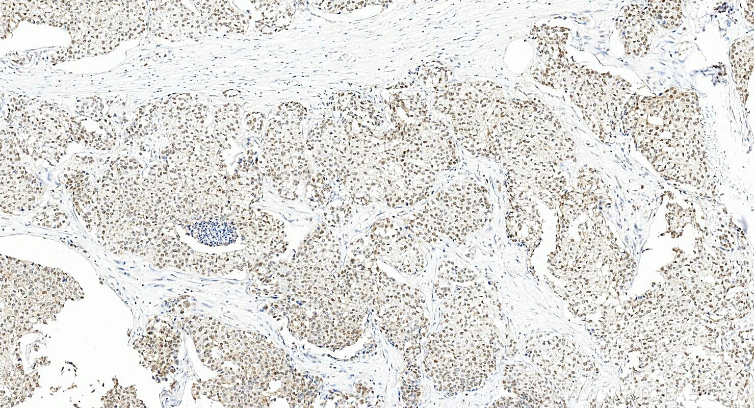 IHC staining of human breast cancer using 28753-1-AP Immunohistochemistry (IHC) staining of human breast cancer tissue using TRPS1 Polyclonal antibody (28753-1-AP)