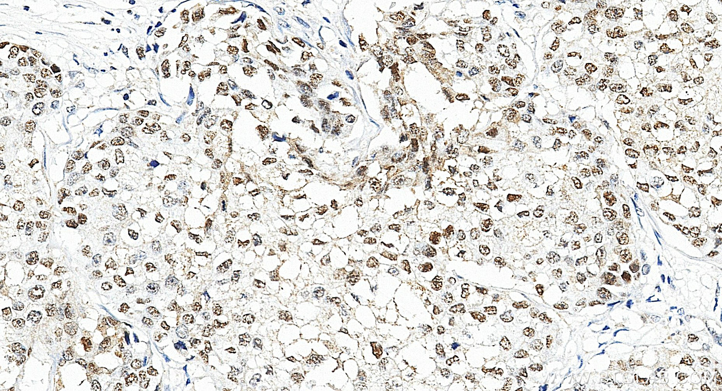 IHC staining of human breast cancer using 28753-1-AP Immunohistochemistry (IHC) staining of human breast cancer tissue using TRPS1 Polyclonal antibody (28753-1-AP)