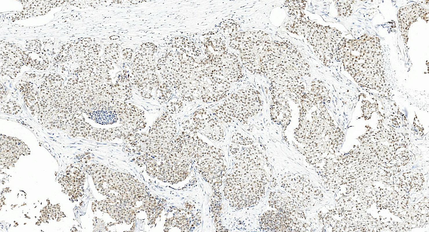 IHC staining of human breast cancer using 83062-4-RR Immunohistochemistry (IHC) staining of human breast cancer tissue using TRPS1 Recombinant monoclonal antibody (83062-4-RR)