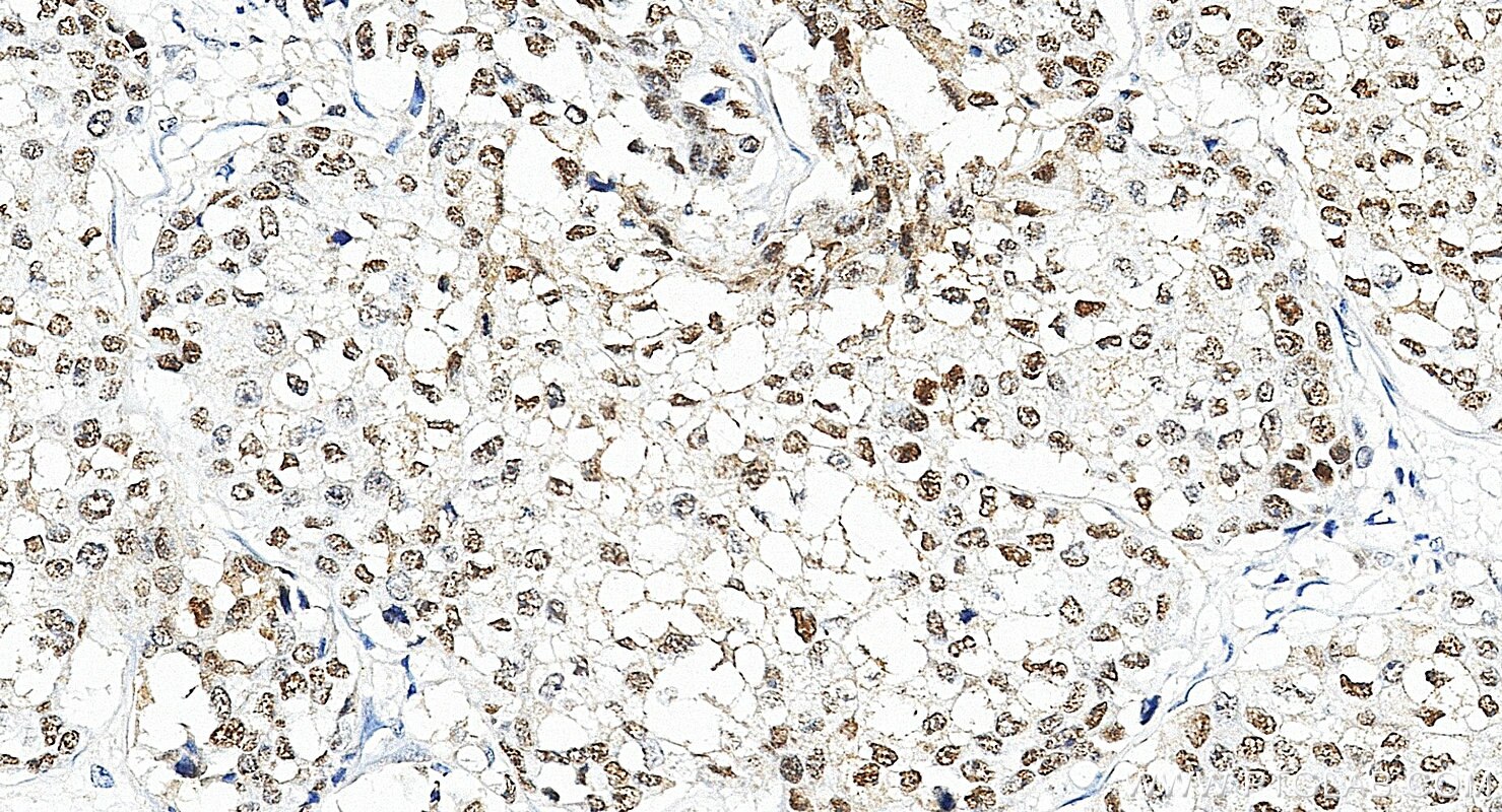 IHC staining of human breast cancer using 83062-4-RR Immunohistochemistry (IHC) staining of human breast cancer tissue using TRPS1 Recombinant monoclonal antibody (83062-4-RR)