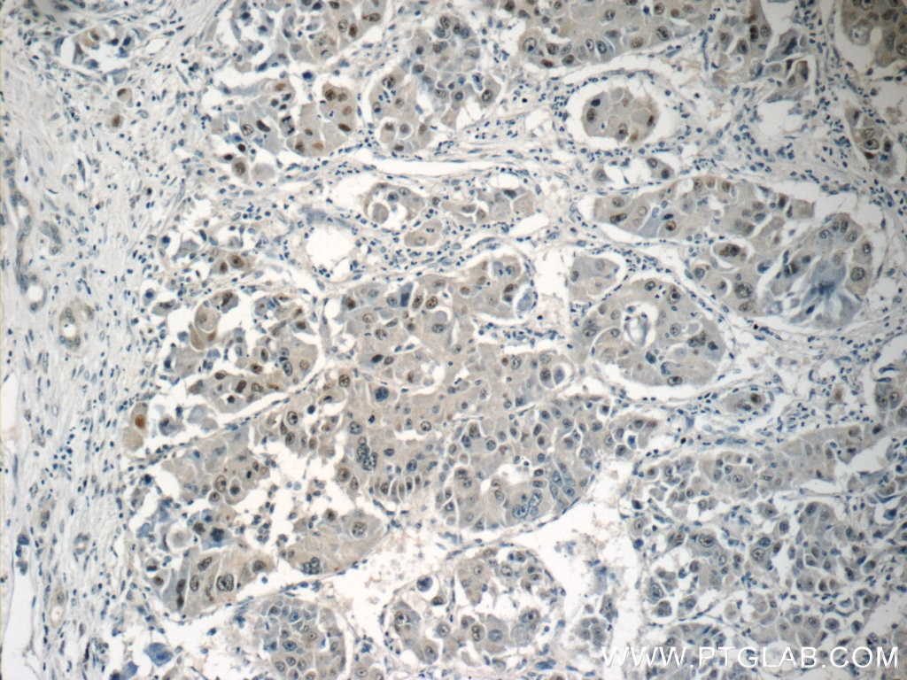 Immunohistochemistry (IHC) staining of human liver cancer tissue using TRPT1 Polyclonal antibody (15541-1-AP)