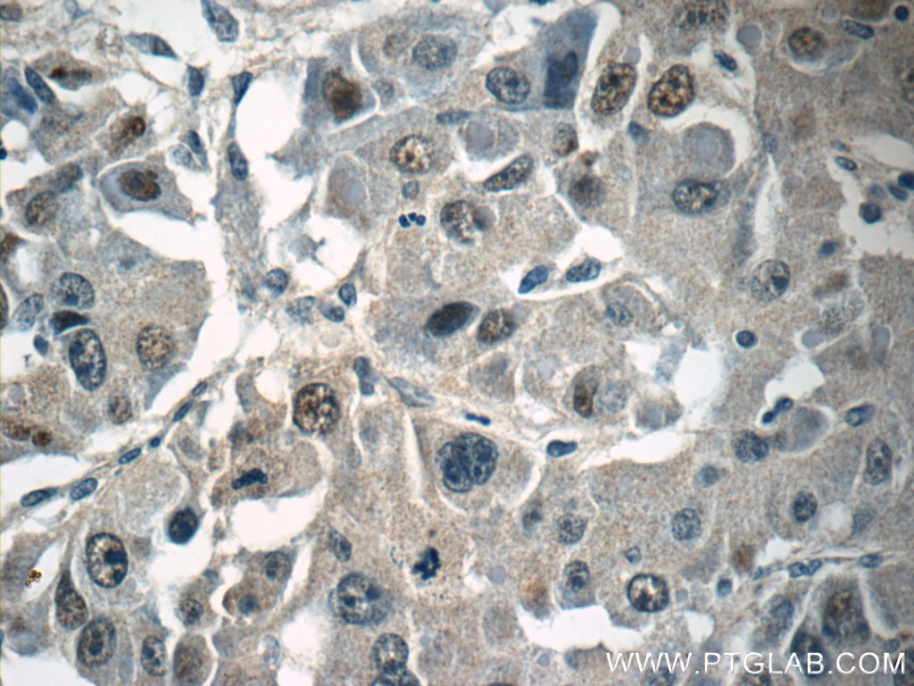 Immunohistochemistry (IHC) staining of human liver cancer tissue using TRPT1 Polyclonal antibody (15541-1-AP)