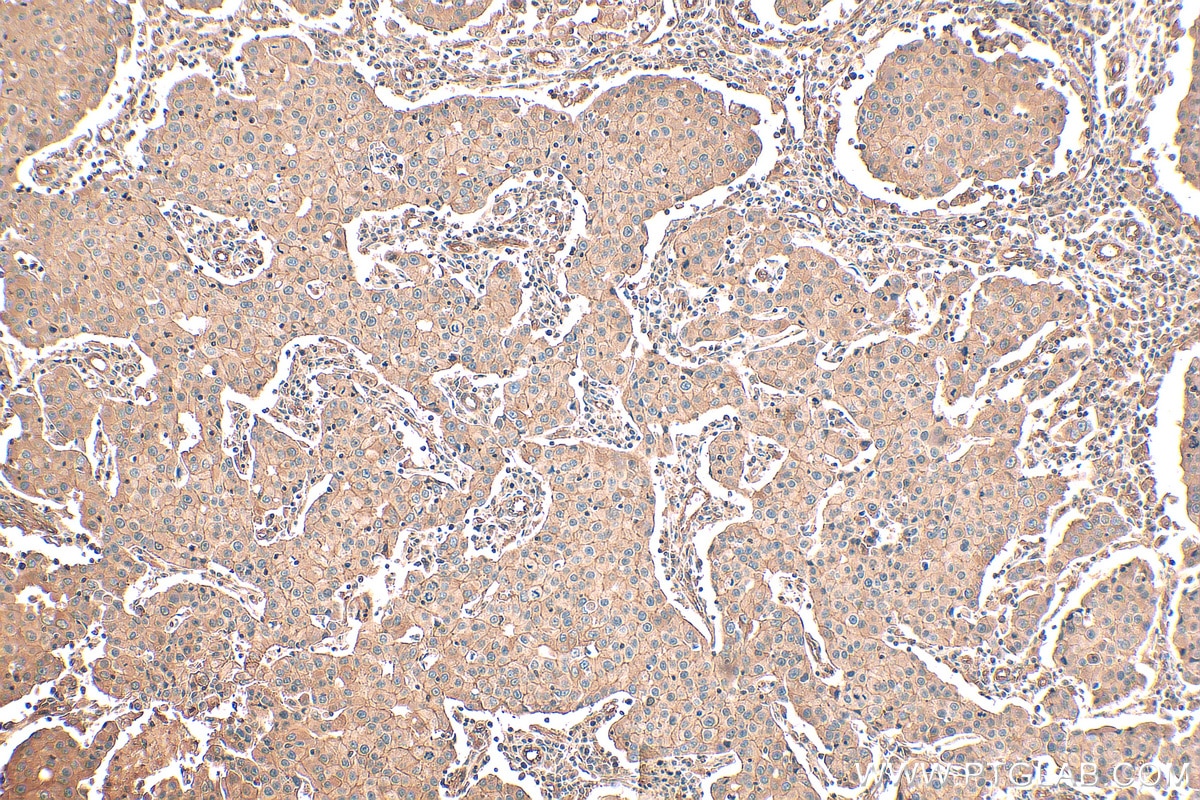 IHC staining of human breast cancer using 29971-1-AP
