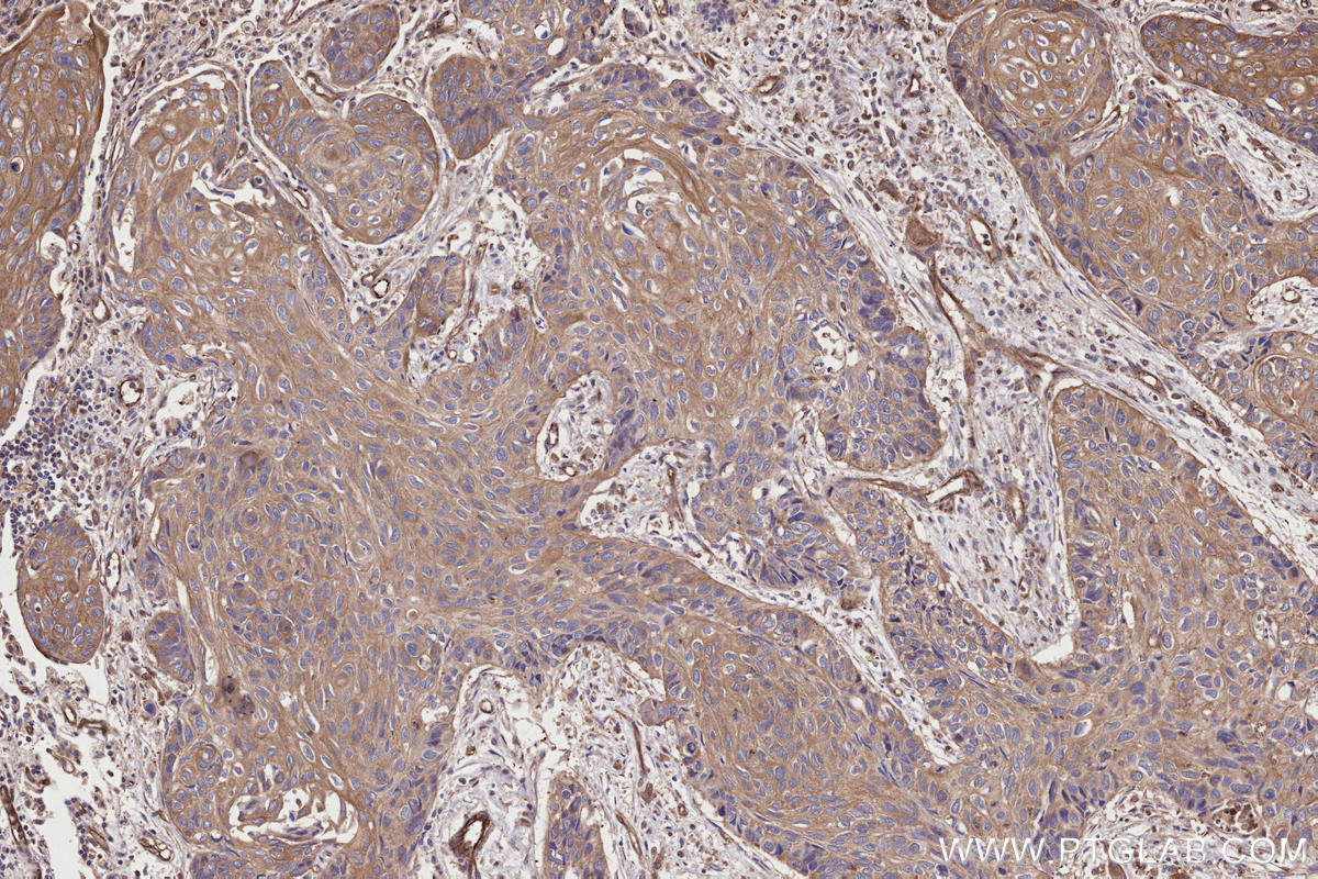 IHC staining of human lung cancer using 29971-1-AP Immunohistochemistry (IHC) staining of human lung cancer tissue using TRPV3 Polyclonal antibody (29971-1-AP)