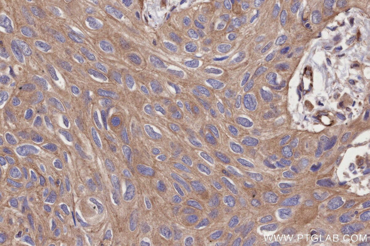 IHC staining of human lung cancer using 29971-1-AP Immunohistochemistry (IHC) staining of human lung cancer tissue using TRPV3 Polyclonal antibody (29971-1-AP)