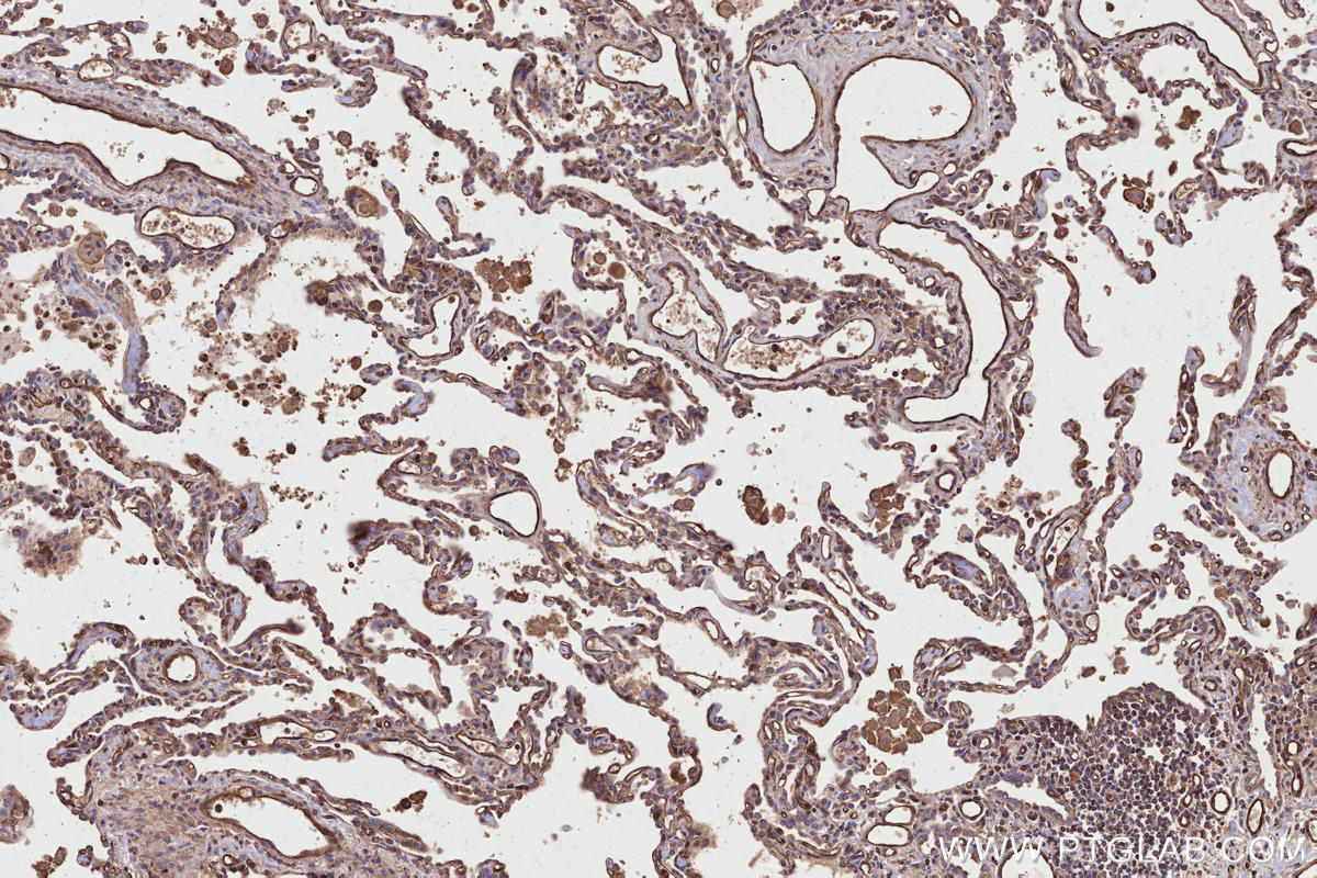 IHC staining of human lung cancer using 29971-1-AP Immunohistochemistry (IHC) staining of human lung cancer tissue using TRPV3 Polyclonal antibody (29971-1-AP)
